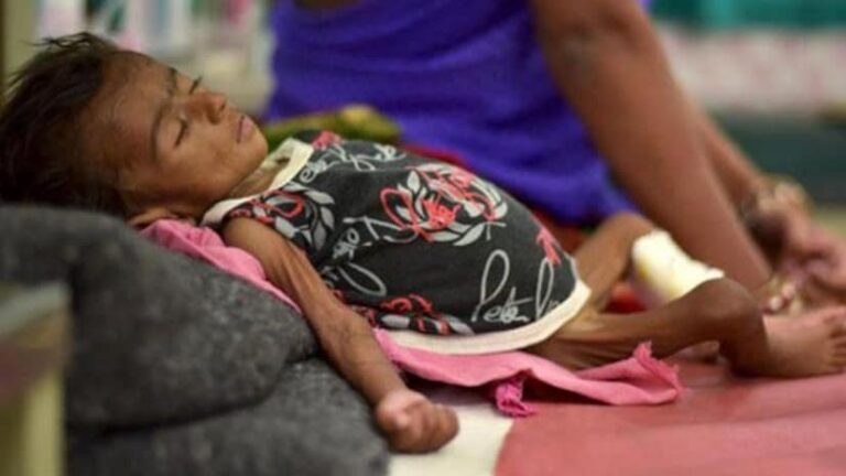Child Malnutrition